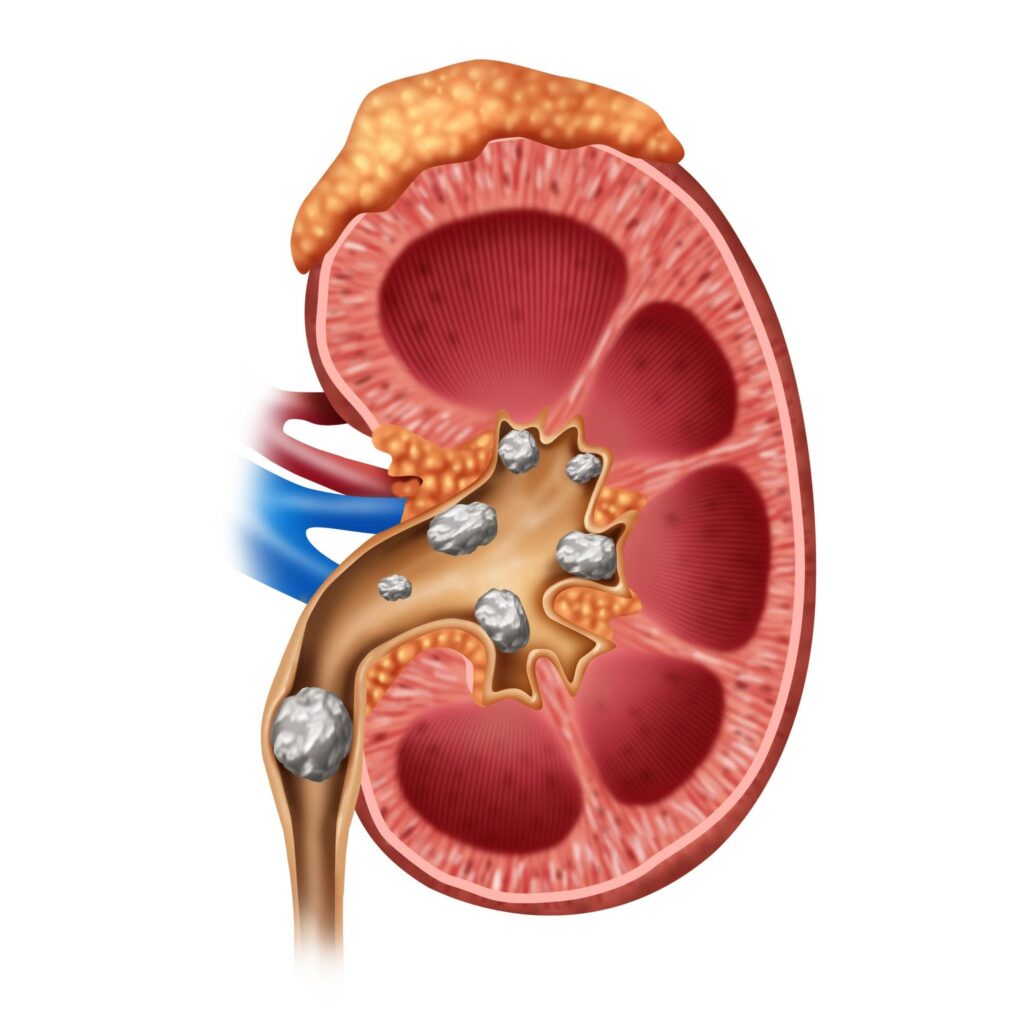  Kidney Stone: किडनीत जमा झालेली घाण बाहेर काढून टाकणे आणि सूज देखील कमी होईल